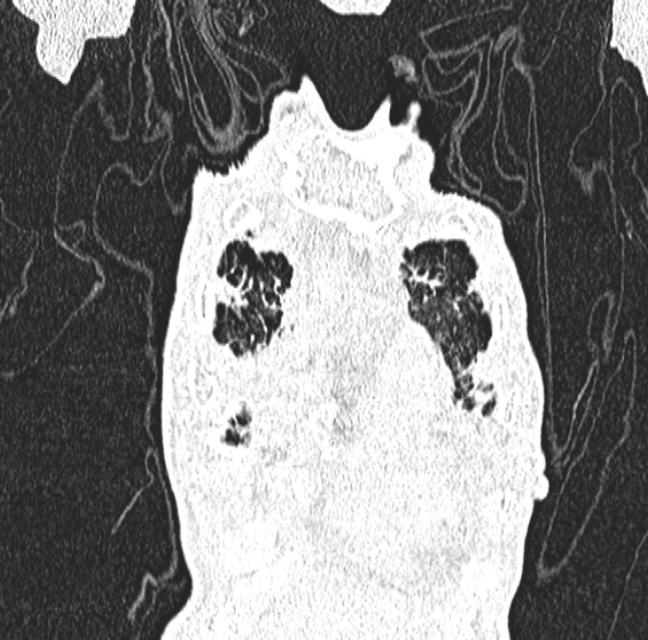 Aspergilloma- with Monod sign (Radiopaedia 44737-48532 Coronal lung window 132).jpg