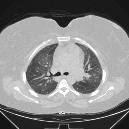 Aspergilloma (Radiopaedia 39611-41932 Axial lung window 48).jpg