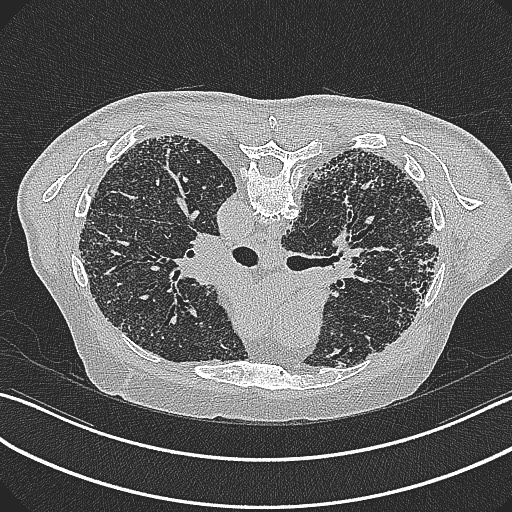 File:Aspergilloma on background pulmonary fibrosis (Radiopaedia 60942-68757 Axial lung window 4).jpg