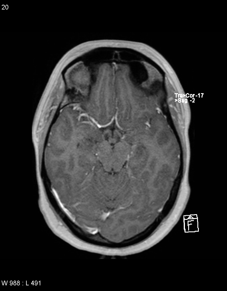 Astroblastoma (Radiopaedia 39792-42217 Axial T1 C+ 19).jpg