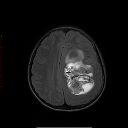 File:Astroblastoma (Radiopaedia 74287-85162 Axial FLAIR 15).jpg