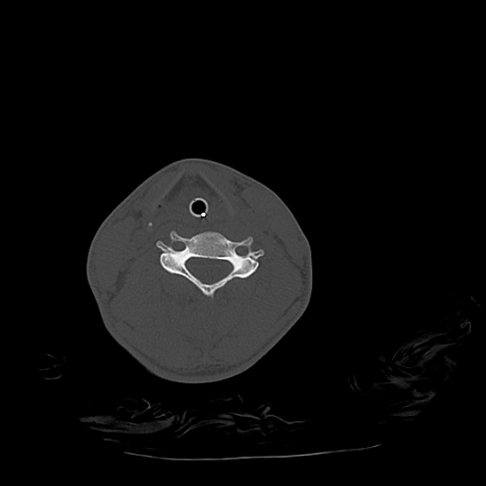 Atlanto-occipital dissociation (Traynelis type 1), C2 teardrop fracture, C6-7 facet joint dislocation (Radiopaedia 87655-104061 Axial bone window 59).jpg