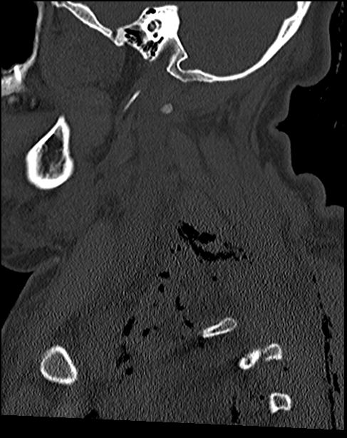 Atlanto-occipital dissociation - Traynelis type 1 (Radiopaedia 87570-103948 Sagittal bone window 27).jpg