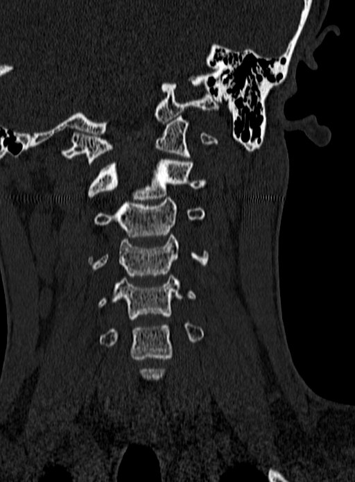 Atlantoaxial subluxation (Radiopaedia 44681-48450 Coronal bone window 47).jpg
