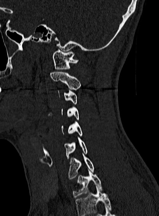Atlantoaxial subluxation (Radiopaedia 44681-48450 Sagittal bone window 124).jpg