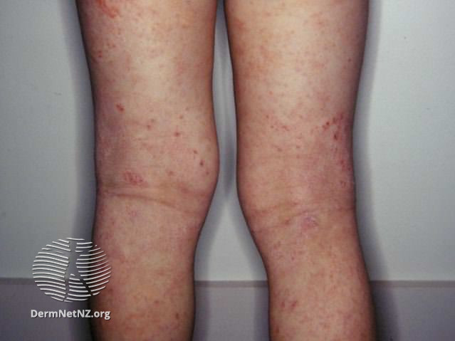 File:Atopic dermatitis (DermNet NZ dermatitis-flexural-eczema11).jpg
