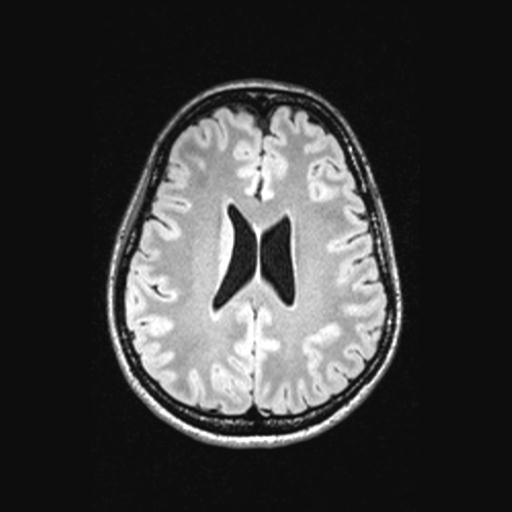 Atretic encephalocoele with inferior vermis hypoplasia (Radiopaedia 30443-31108 Axial 102).jpg