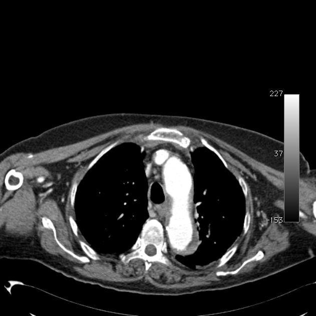 Atypical dissection of the thoracic aorta (Radiopaedia 10975-11393 A 17).jpg