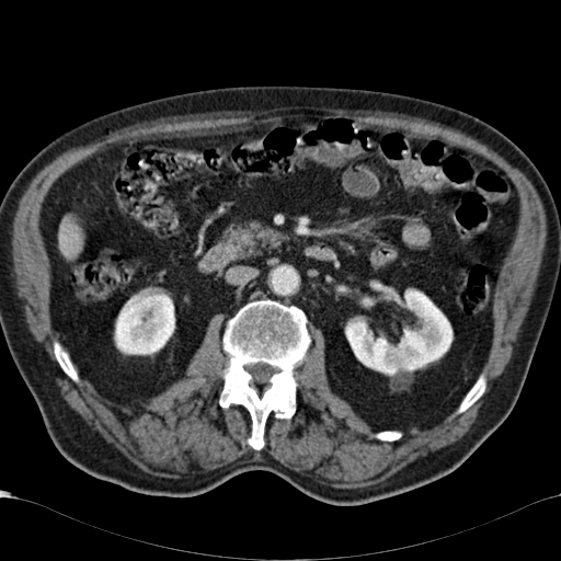 Atypical hepatocellular carcinoma (Radiopaedia 41744-44698 B 48).jpg