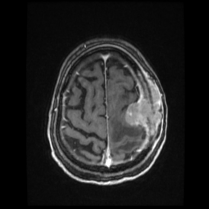 Atypical meningioma (Radiopaedia 45535-49629 Axial T1 C+ 56).jpg