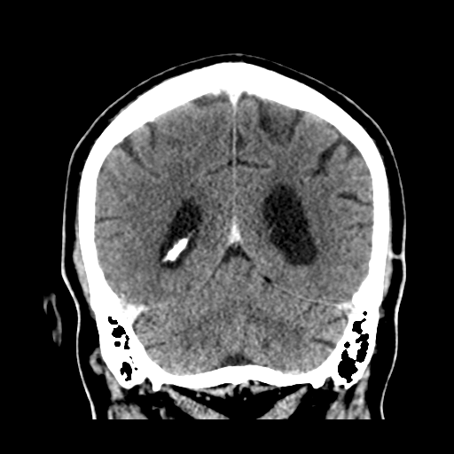 Atypical meningioma (WHO grade II) with brain invasion (Radiopaedia 57767-64728 Coronal C+ 45).png