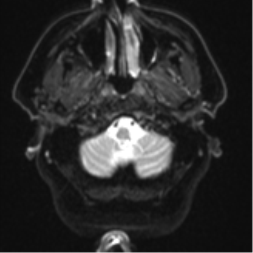 Atypical meningioma (WHO grade II) with brain invasion (Radiopaedia 57767-64729 Axial DWI 3).png