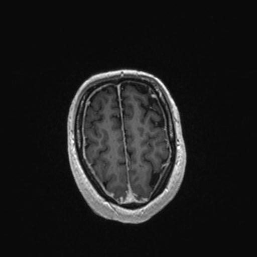 Atypical meningioma (grade II) - en plaque (Radiopaedia 29633-30147 Axial T1 C+ 154).jpg