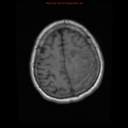 File:Atypical meningioma - grade II (Radiopaedia 13303-13305 Axial T1 18).jpg