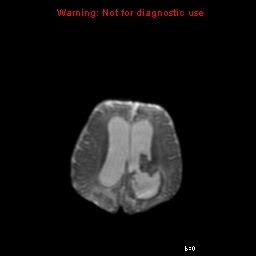 File:Atypical teratoid rhabdoid tumor (Radiopaedia 10712-11183 Axial DWI 6).jpg
