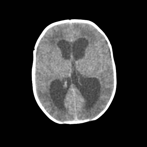 File:Atypical teratoid rhabdoid tumor (prenatal US and neonatal MRI) (Radiopaedia 59091-66387 Axial non-contrast 23).jpg