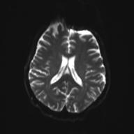 Autoimmune limbic encephalitis (Radiopaedia 30363-31005 Axial B0 and DWI 20).jpg