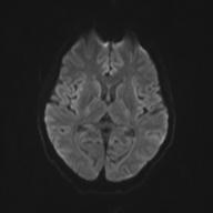 Autoimmune limbic encephalitis (Radiopaedia 30363-31005 Axial B0 and DWI 49).jpg