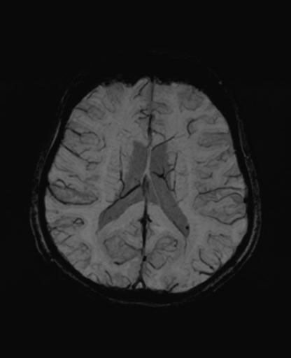 Autoimmune limbic encephalitis (Radiopaedia 30363-31005 SWI - mIP 45).jpg