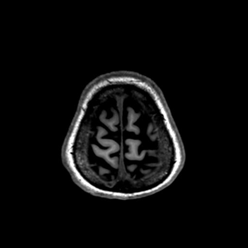 File:Autoimmune limbic encephalitis (Radiopaedia 30363-31005 T1 Axial 1mm 138).jpg