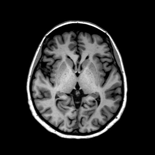 Autoimmune limbic encephalitis (Radiopaedia 30363-31005 T1 Axial 1mm 77).jpg