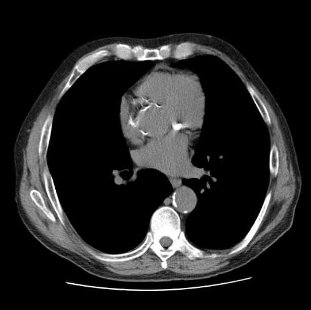 Autosomal dominant polycystic kidney disease (Radiopaedia 27851-28094 Axial non-contrast 32).jpg