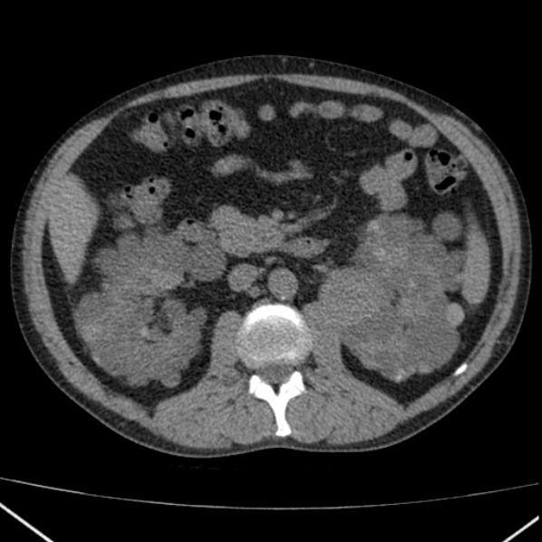 File:Autosomal dominant polycystic kidney disease (Radiopaedia 36539-38101 Axial non-contrast 37).jpg
