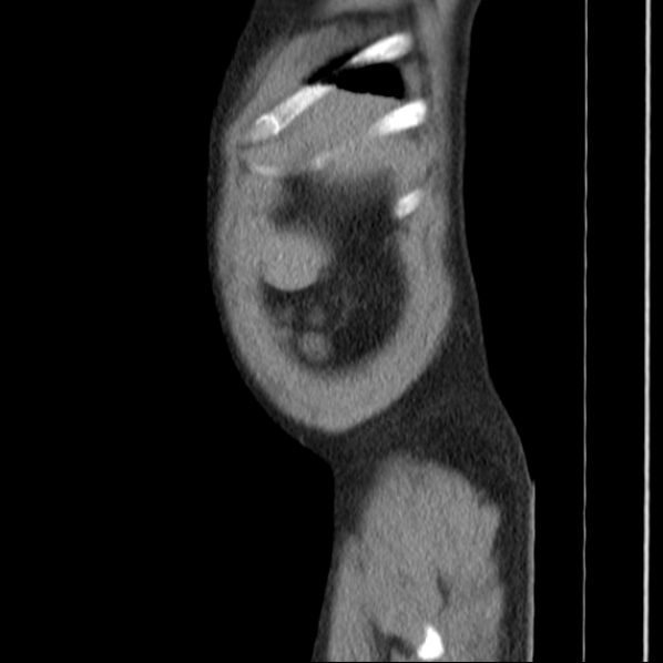 Autosomal dominant polycystic kidney disease (Radiopaedia 36539-38101 D 8).jpg