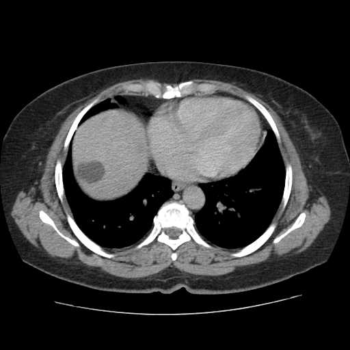 File:Autosomal dominant polycystic kidney disease with hepatic involvement (Radiopaedia 32693-33662 C 4).jpg