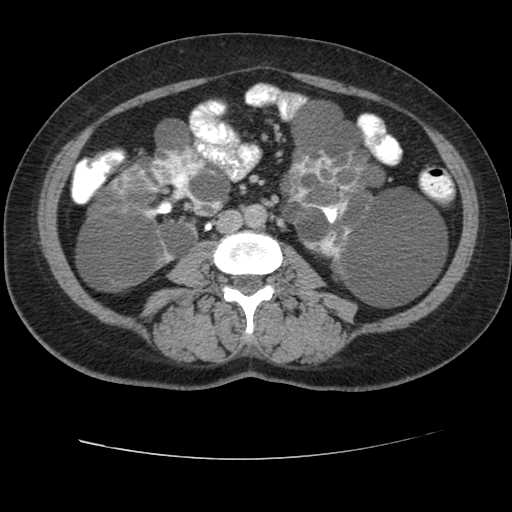 Autosomal dominant polycystic kidney disease with hepatic involvement (Radiopaedia 32693-33662 C 44).jpg