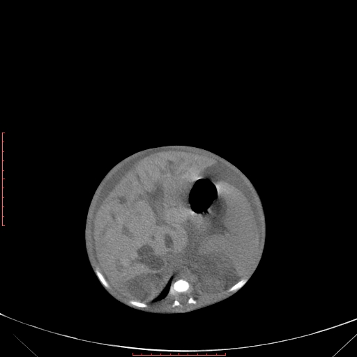 File:Autosomal recessive polycystic kidney disease associated with Caroli disease (Radiopaedia 61932-69984 Axial non-contrast 148).jpg
