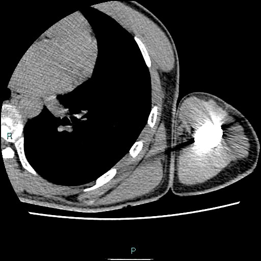 File:Avascular necrosis after fracture dislocations of the proximal humerus (Radiopaedia 88078-104653 D 87).jpg