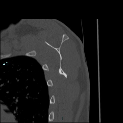 Avascular necrosis after fracture dislocations of the proximal humerus (Radiopaedia 88078-104653 Sagittal bone window 55).jpg