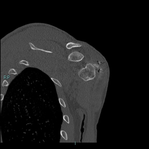 Avascular necrosis after fracture dislocations of the proximal humerus (Radiopaedia 88078-104655 Coronal bone window 101).jpg