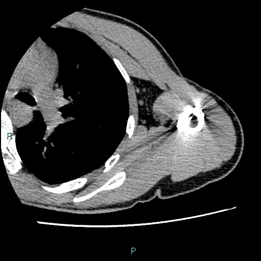 File:Avascular necrosis after fracture dislocations of the proximal humerus (Radiopaedia 88078-104655 D 79).jpg