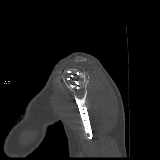 Avascular necrosis after fracture dislocations of the proximal humerus (Radiopaedia 88078-104655 Sagittal bone window 13).jpg