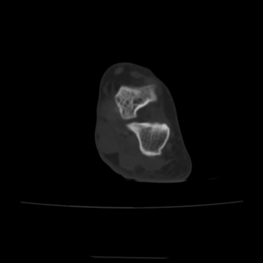 Avulsion fracture of the dorsal cuboid bone (Radiopaedia 51586-57377 Axial bone window 45).jpg