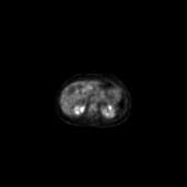 B-cell lymphoma of the mesentery (Radiopaedia 65743-74868 18F-FDG PET-CT 155).jpg