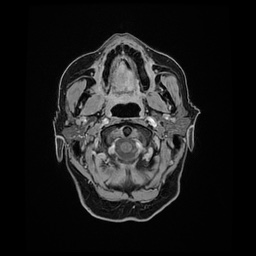 Balo concentric sclerosis (Radiopaedia 53875-59982 Axial LAVA C+ 17).jpg