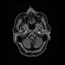 File:Balo concentric sclerosis (Radiopaedia 53875-59982 Axial LAVA C+ 32).jpg