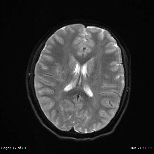 Balo concentric sclerosis (Radiopaedia 61637-69636 Axial DWI 17).jpg