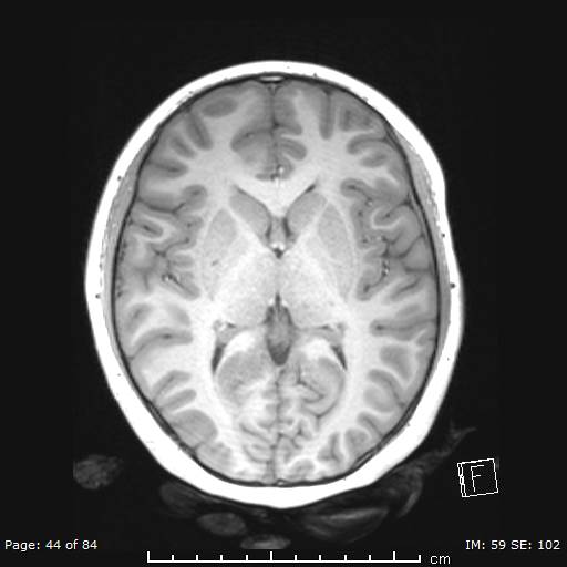 Balo concentric sclerosis (Radiopaedia 61637-69636 Axial T1 44).jpg