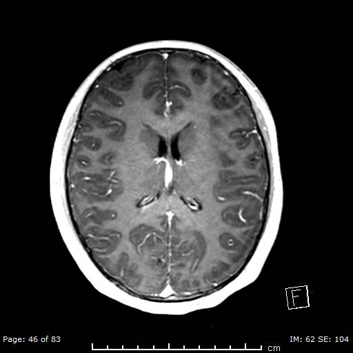 File:Balo concentric sclerosis (Radiopaedia 61637-69636 Axial T1 C+ 46).jpg