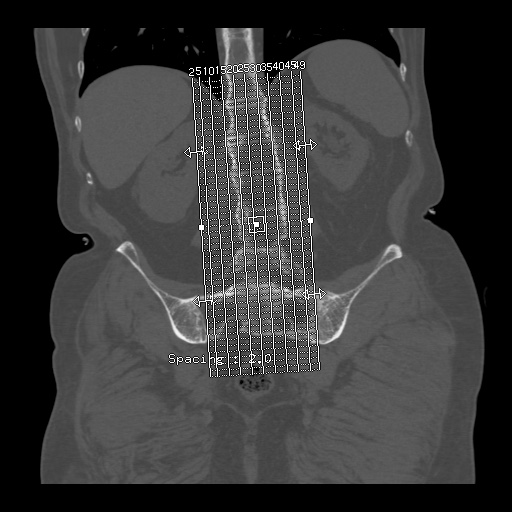 File:Bamboo spine (Radiopaedia 61848-69879 Sagittal bone window 1).jpg