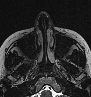 File:Basal cell carcinoma - nasal region (Radiopaedia 70292-80365 Axial Gradient Echo 6).jpg