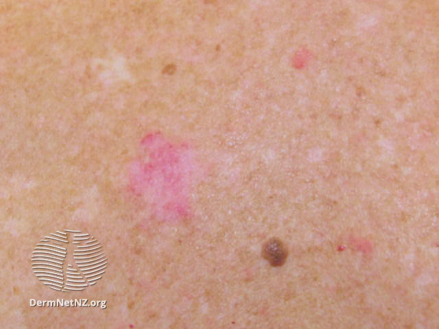 File:Basal cell carcinoma affecting the trunk (DermNet NZ lesions-bcc-trunk-0690).jpg