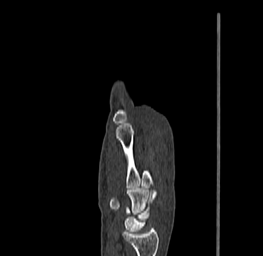 Base of 2nd metacarpal fracture (Radiopaedia 73741-84544 Sagittal bone window 36).jpg