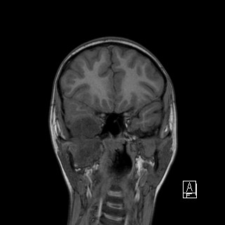 Base of skull rhabdomyosarcoma (Radiopaedia 32196-33142 Coronal T1 13).jpg