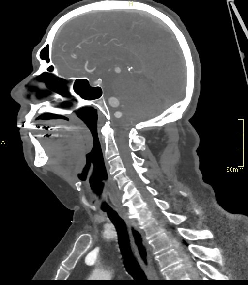 Basilar artery aneurysm (Radiopaedia 56261-62932 C 28).jpg
