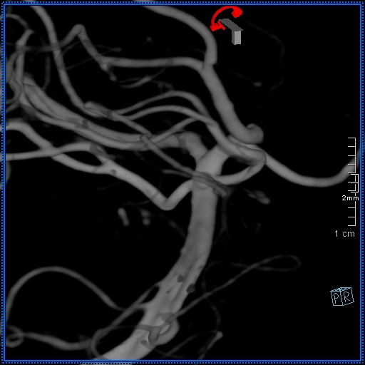 Basilar artery perforator aneurysm (Radiopaedia 82455-99524 3D Left VA 75).jpg